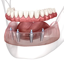 Artistic rendering of implant dentures