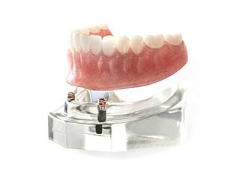 Model of implant dentures